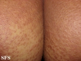 scleromyxedema