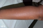 scleromyxedema