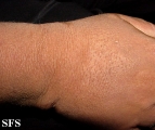 scleromyxedema