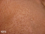 scleromyxedema