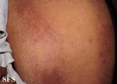 scleromyxedema
