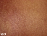 scleromyxedema