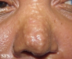scleromyxedema