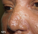 scleromyxedema