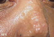 scleromyxedema