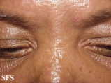 scleromyxedema