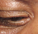 scleromyxedema
