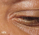 scleromyxedema