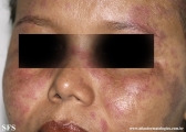 lupus erythematosus-systemic