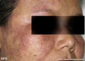 lupus erythematosus-systemic
