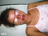 lupus erythematosus-systemic
