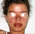 lupus erythematosus-systemic
