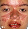 lupus erythematosus-systemic