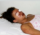 lupus erythematosus-systemic