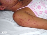 lupus erythematosus-systemic