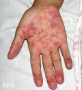 lupus erythematosus-systemic