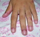 lupus erythematosus-systemic