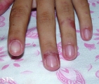 lupus erythematosus-systemic
