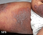 pemphigus vegetans