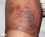 pemphigus vegetans