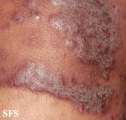 pemphigus vegetans
