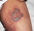 pemphigus vegetans