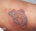 pemphigus vegetans