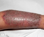 pemphigus vegetans