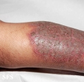 pemphigus vegetans