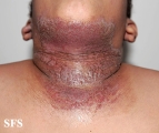 pemphigus vegetans