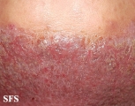pemphigus vegetans