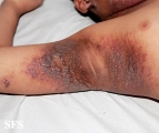 pemphigus vegetans