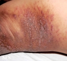 pemphigus vegetans