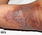 pemphigus vegetans