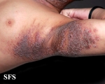 pemphigus vegetans
