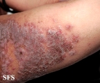 pemphigus vegetans