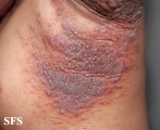 pemphigus vegetans