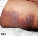 pemphigus vegetans