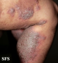 pemphigus vegetans