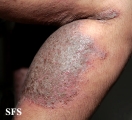 pemphigus vegetans