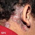 pemphigus vegetans