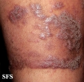 pemphigus vegetans