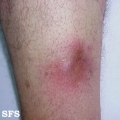 mycobacterial infections-atypical