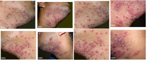 herpetic sycosis
