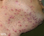 herpetic sycosis