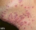 herpetic sycosis