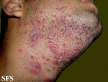 herpetic sycosis