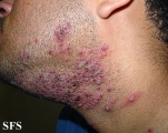 herpetic sycosis
