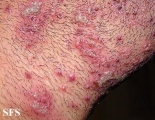 herpetic sycosis