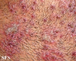 herpetic sycosis